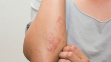 PasteThe Best Homeopathic Treatment for Skin Conditions