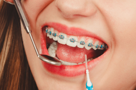 Thornton Braces: What to Expect in the First 90 Days