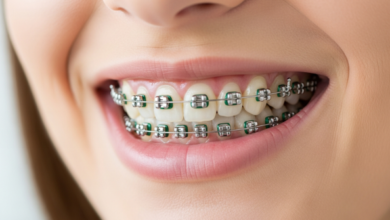Braces Treatment: What to Expect from Consultation to Results
