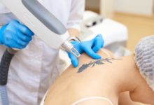 Laser vs Surgery Tattoo Removal in Islamabad