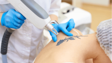 Laser vs Surgery Tattoo Removal in Islamabad