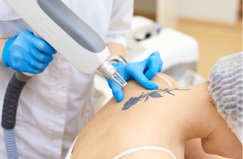Laser vs Surgery Tattoo Removal in Islamabad