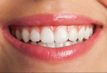 Is Professional Teeth Whitening Worth It? A Dentist Explains What Patients in Kent Should Know