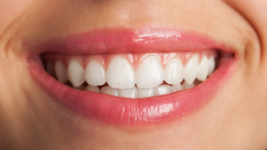 Is Professional Teeth Whitening Worth It? A Dentist Explains What Patients in Kent Should Know