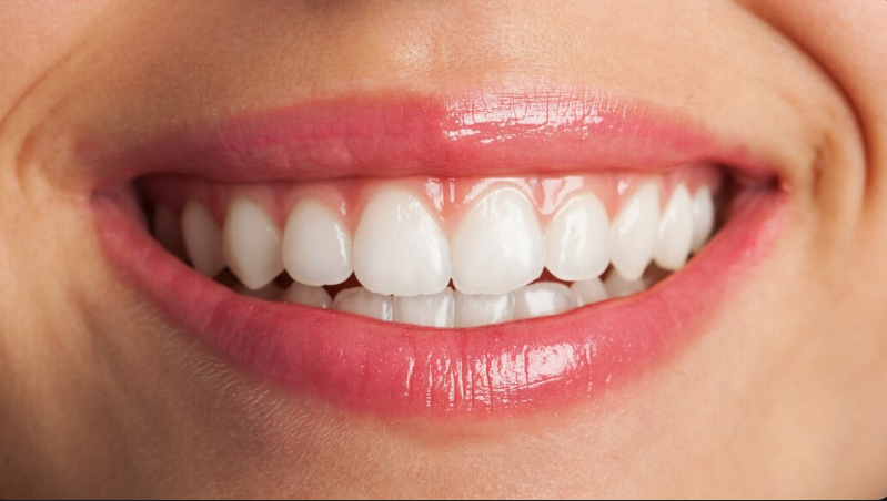 Is Professional Teeth Whitening Worth It? A Dentist Explains What Patients in Kent Should Know