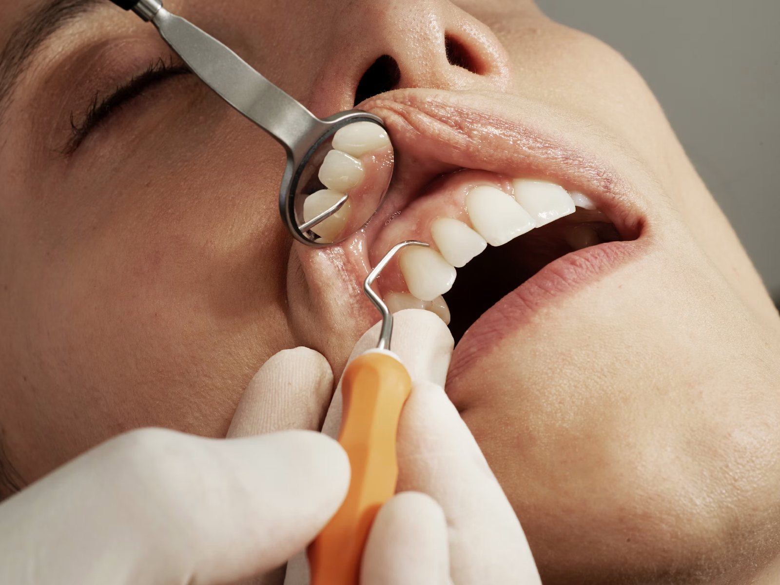 Dental Implants vs Bridges: Which Tooth Replacement Is Better